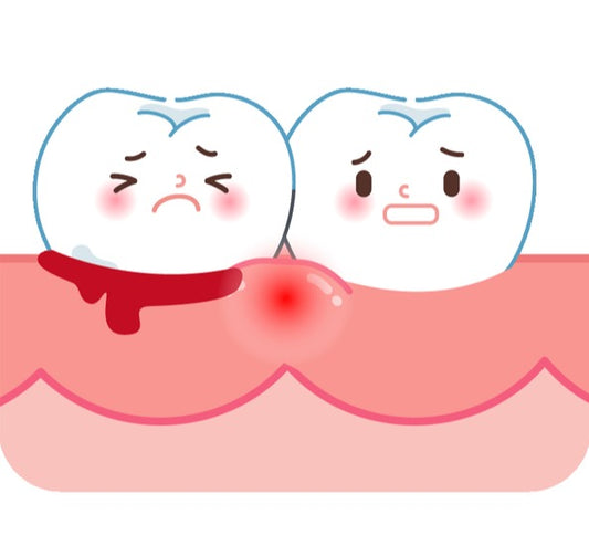 Why Gums Bleed and How to Prevent It?